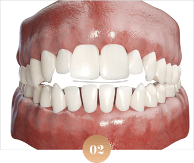 토끼 모양의 치아