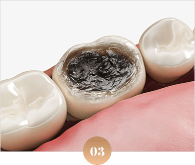 파절/충치로 많이 손상된 치아