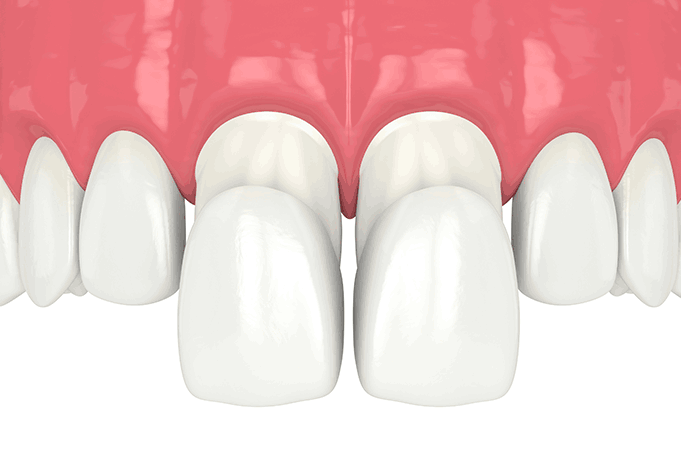 일반 라미네이트 삭제량