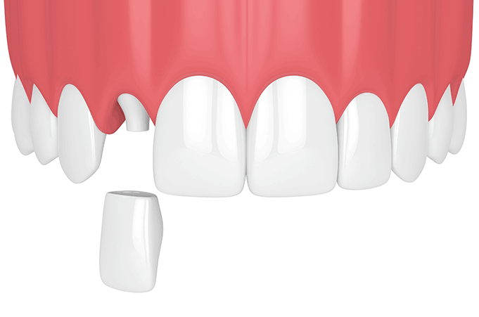 일반 크라운 삭제량