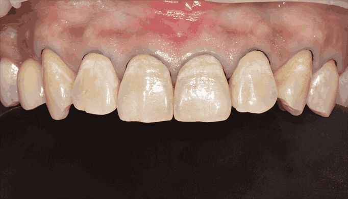 VIEW 비니쉬 삭제 전