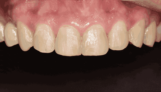 VIEW 비니쉬 미세삭제 후