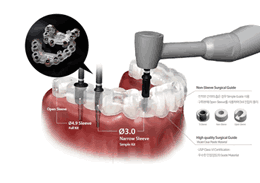 네비게이션 임플란트
