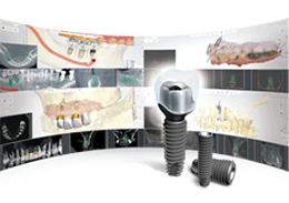 네비게이션 임플란트