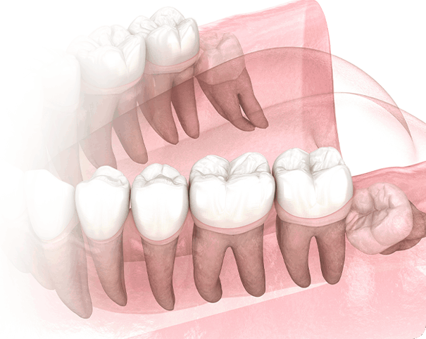 사랑니 발치, 중요 포인트