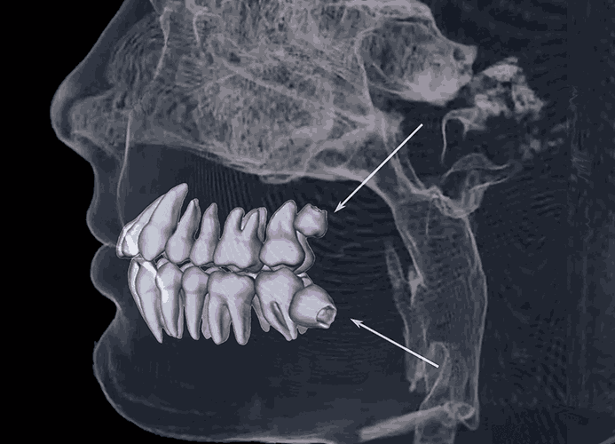 사랑니 발치가 늦어지면 발생하는 문제점