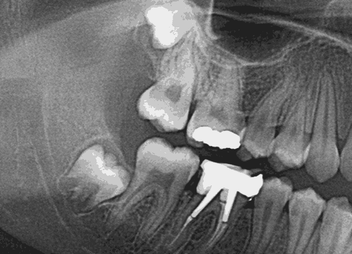 사랑니 발치가 늦어지면 발생하는 문제점