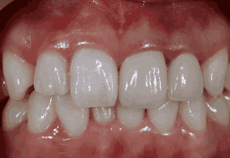 지르코니아 크라운 치료과정01