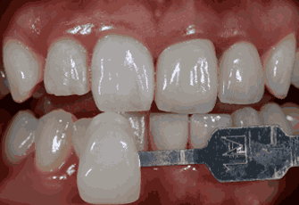 지르코니아 크라운 치료과정02