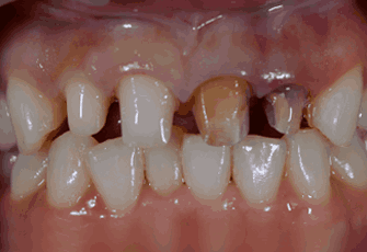 지르코니아 크라운 치료과정03