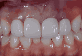 지르코니아 크라운 치료과정04