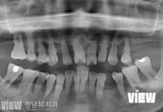 전후사진 이미지
