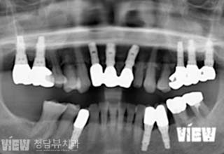 전후사진 이미지