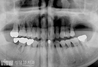 전후사진 이미지