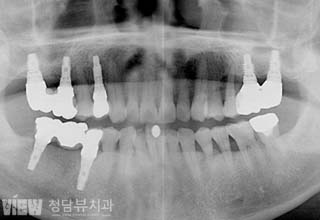 전후사진 이미지