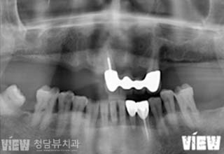 임플란트