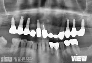 임플란트