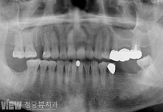 전후사진 이미지
