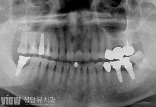 전후사진 이미지